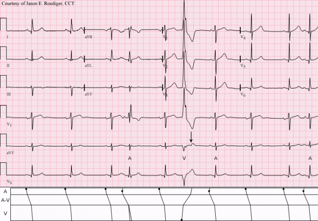 Rabbit Ear Sign ECG Guru Instructor Resources   ECG Of The Week 1y Answer 